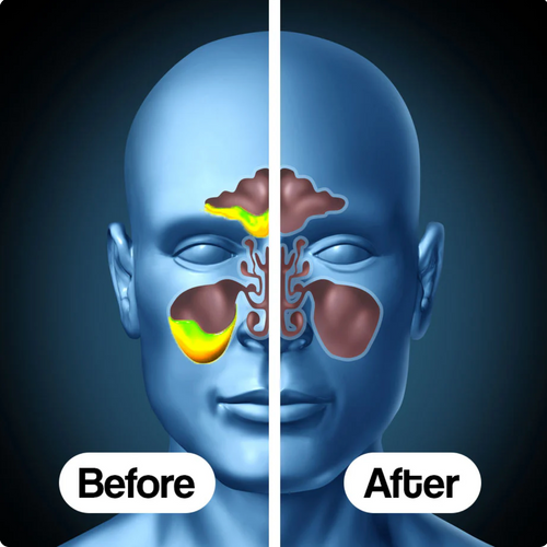 Nasennebenhöhlen-Drainagegerät + GRATISGESCHENK